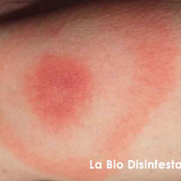 Zecche acari del piccione lesioni e punture