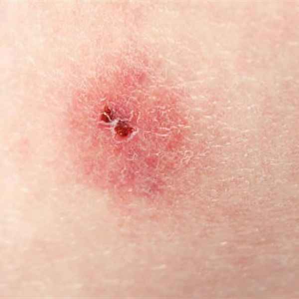 Morso puntura zecca del piccione